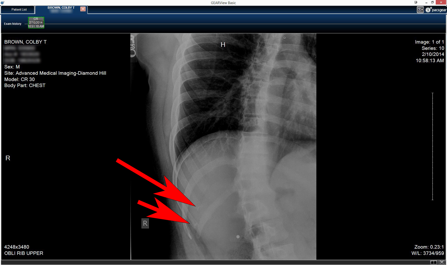 Colby_Brown_Rib_Injury_Iceland